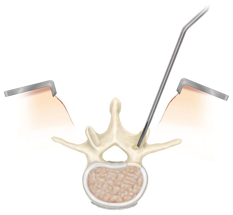 open lumbar spine surgery