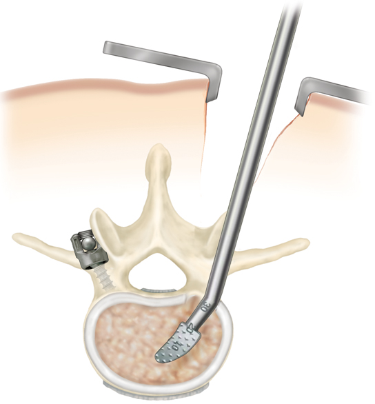 wiltse approach, minimally invasive spine surgery