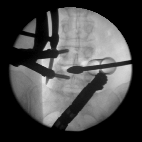 minimally invasive spine surgery, back surgery