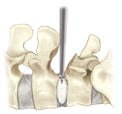 minimally invasive spine surgery, interbody graft