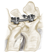 pedicle screws in lumbar spine