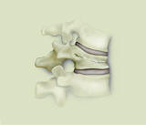 kyphoplasty spinal osteoporotic compression fracture houston, texas
