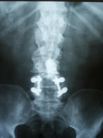 pedicle screws; fusion; lumbar x ray scan; low back pain