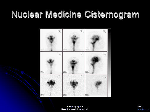 nuclear medicine cisternogram in patient with nph