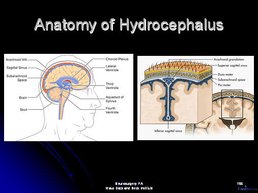 brain anatomy of normal pressure hydrocephalus