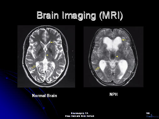 mri brain scans of nph