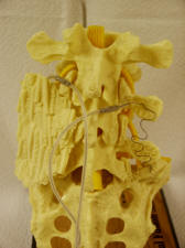 fusion of the lumbar spine; bone growth stimulator
