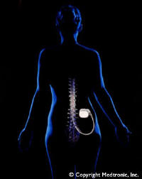 medtronic (mdt) spinal cord stimulator, houston, texas, west houston, river oaks, neurosurgeon, neurosurgery, surgery