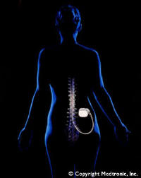 spinal cord stimulator horror stories