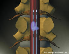 medtronic (mdt) spinal cord stimulator, houston, texas, west houston, river oaks, neurosurgeon, neurosurgery, surgery