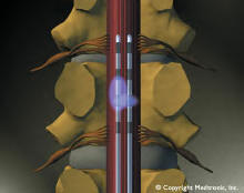 medtronic dorsal column stimulator array