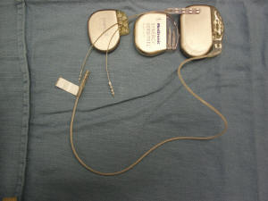 spinal implant stimulator