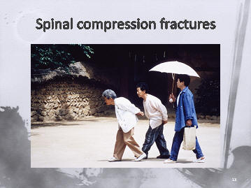 osteoporotic compression fractures of the spine in a Korean family, Houston, Texas