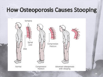 what happens to the spine with compression fractures