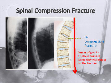 osteoporotic compression fracture of the spine causes kyphosis, increasing risk to adjacent levels, Houston, Texas