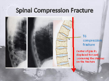 osteoporosis spinal compression fracture treatment