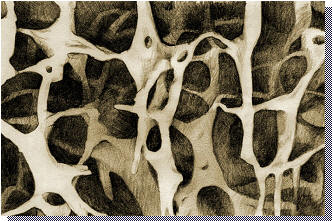 osteoporosis bone density, osteoporotic bone