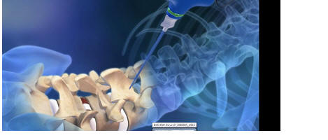 jamshidi needle in pedicle of spine, minimally invasive spinal surgery