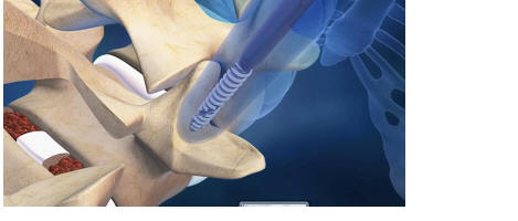 pedicle tap, with sextant, medtronic, minimally invasive spinal surgery